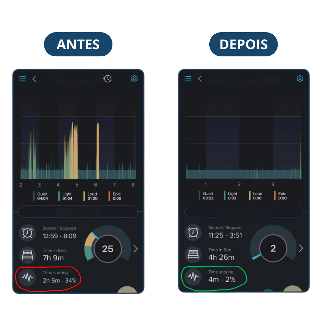 Sonar+ Benevita® - Protetor Bucal Anti-Ronco - OFERTA BLACK ESTENDIDA🔥 LEVE MAIS PAGANDO MENOS (ÚLTIMO DIA)